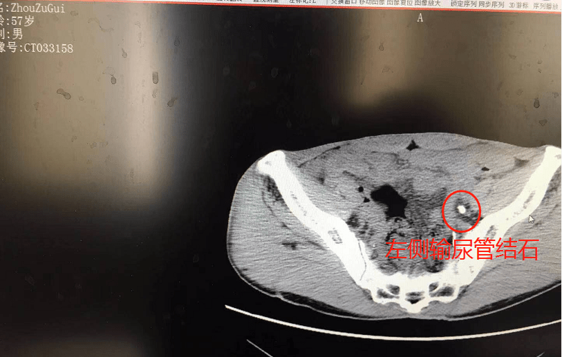 突發腰痛別小視湖北大叔突感腰痛經查巨大腎結石致腎功能受損