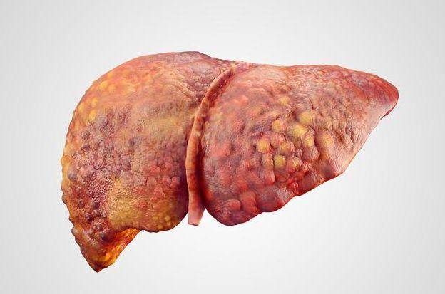 肝脏|肝癌的元凶终于找到了，喝酒排在第三位，排在首位的你压根没重视