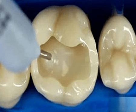 什么情况才需要补牙 6a3264016cb1446aa1efb7fb96a8d255.png