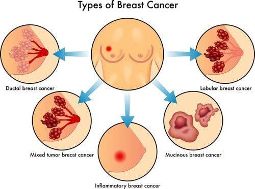 【术后须知】降低早期乳腺癌术后复发风险