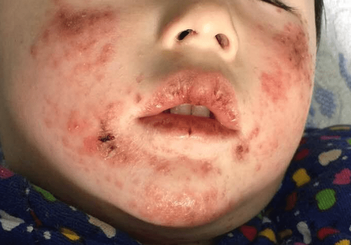 儿童面部疱疹图片