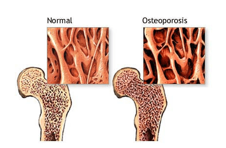 减缓骨转化,延长骨矿化周期,久而久之会导致骨质疏松