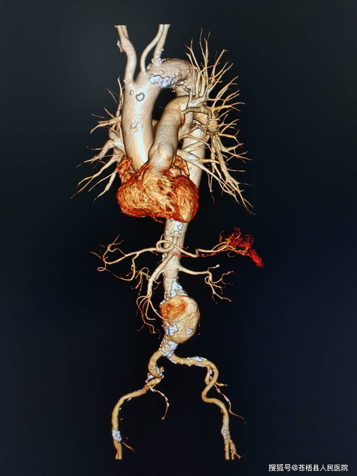 苍梧县人民医院又添新利器飞利浦64排128层高端螺旋ct正式投入使用