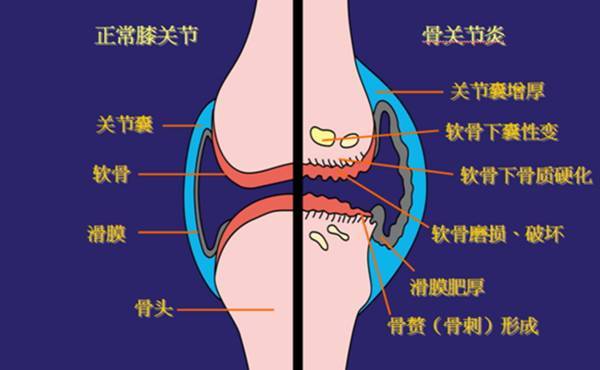 夏天吹空调真的容易引发膝关节炎吗
