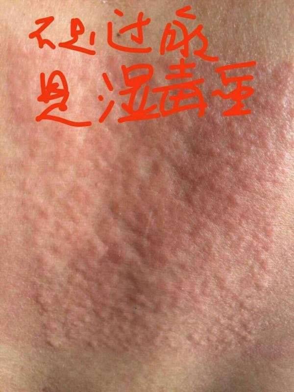 过敏是什么呢