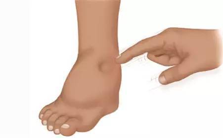 症状|这4个前兆早发现,肝硬化或有回旋余地