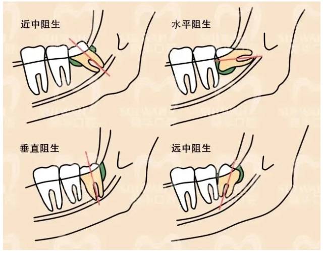 智齒不拔可以嗎關於智齒的一些真相都在這裡