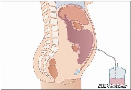 治疗|唐跃良 腹腔积液该如何解决？