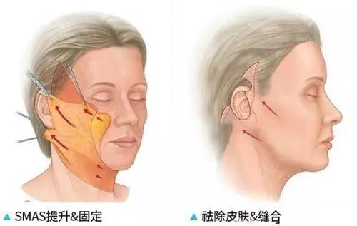 面部|李方奇解析：面部抗衰用小切口提升术到底有没有用？