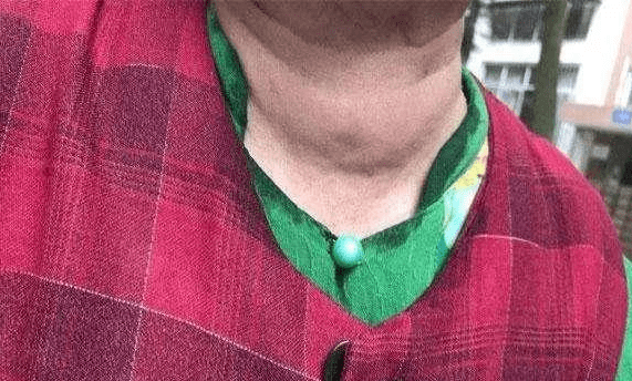 生活|得了甲状腺疾病,应该怎么吃?甲状腺专家景录先:这4种食物再想吃也要控制!