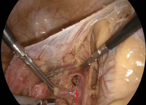 输尿管|这疝实属罕见！天津市人民医院成功为输尿管坐骨大孔疝患者实施腹腔镜微创术