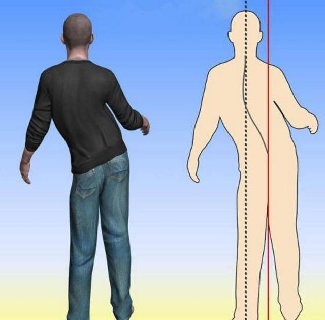 偏瘫步态,是偏瘫患者下肢伸直,走路会呈现出划圈的问题,人们常常称