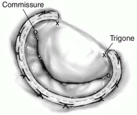 治疗|反复发烧2个多月，17岁女孩患的这种少见病经高难手术精巧治愈
