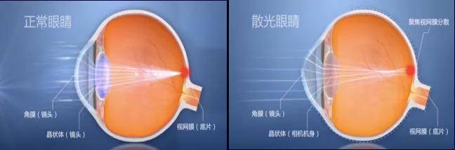 屈光|如何防止散光加深？