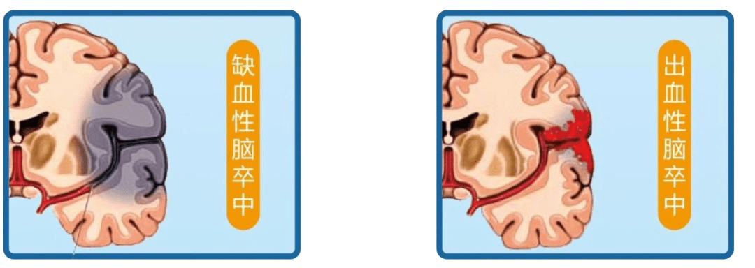 抢救|脑卒中救治 把握“黄金抢救期”