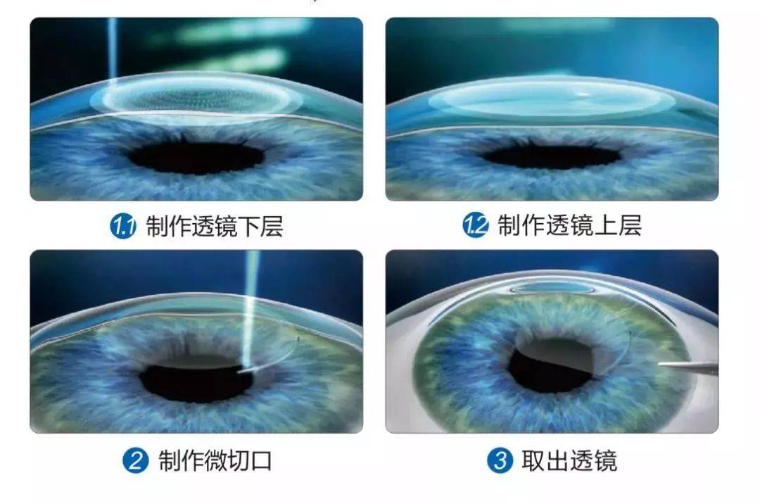 【科視眼科】近視手術真的越貴越好嗎?