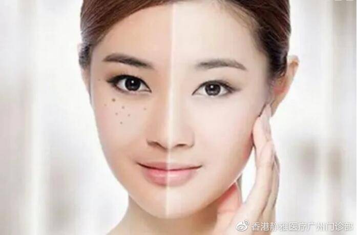 进行|黄褐斑该怎么进行预防