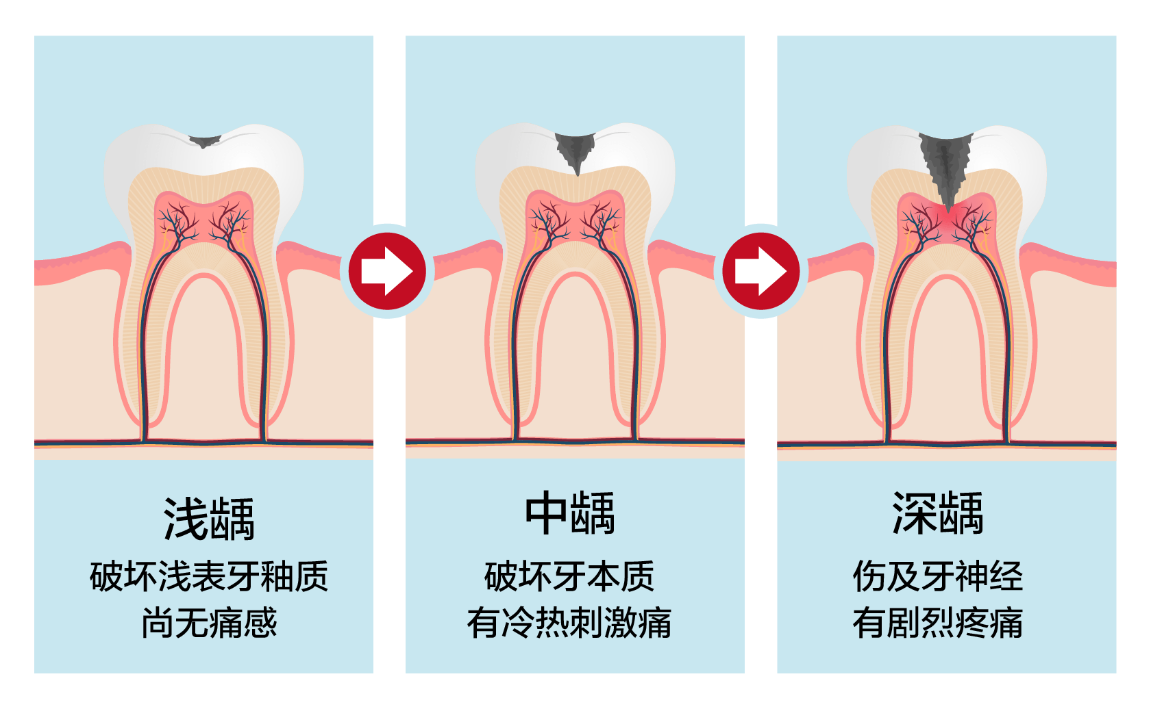 正所谓"小洞不补,大洞吃苦,浅龋→中龋→深龋是个不断演变的过程.