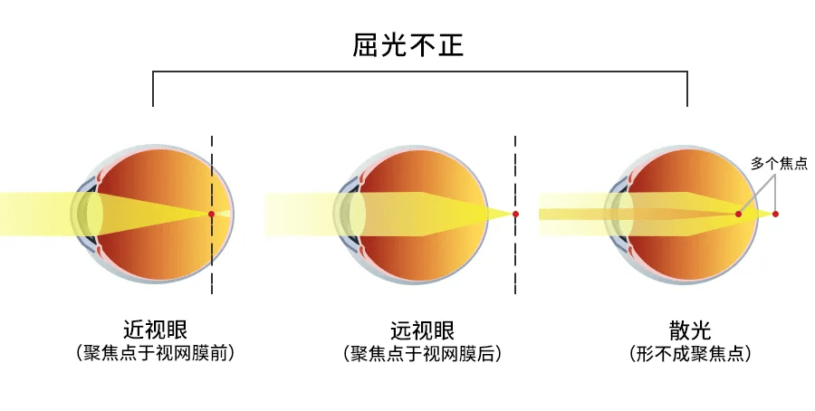 近视眼镜成像示意图图片