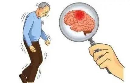 诊断|正确认识多系统萎缩,及时发现症状,及时干预良好预后。