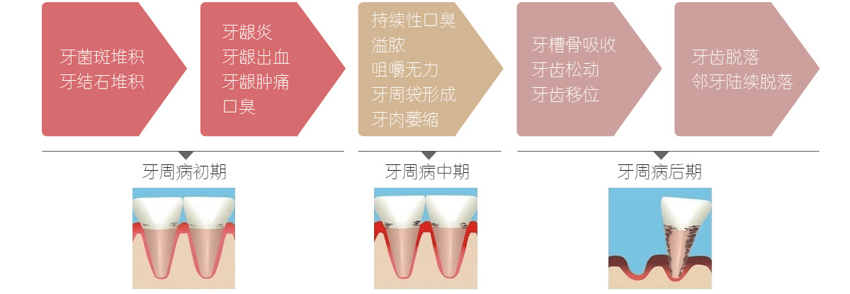 主要是患牙出现明显的晃动并移位,严重的会出现牙齿脱落,牙周袋深度