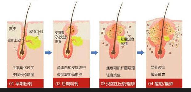 缺乏营养U牌：日常哪些习惯可以改善痘痘