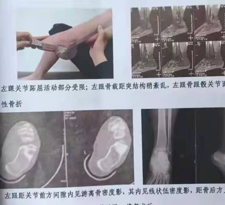 职业|四川先市高级学校的14岁少女,被学姐不分青红皂白体罚致残!