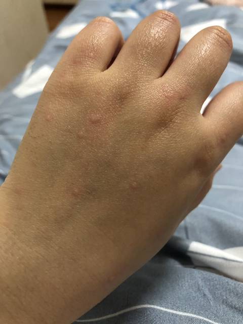 小孩大腿两侧有湿疹怎么办