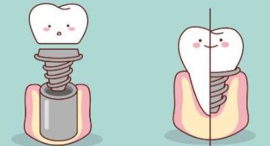 种牙最好什么时间 8b69430424e24fd6bee6cc81ad97a695.jpeg