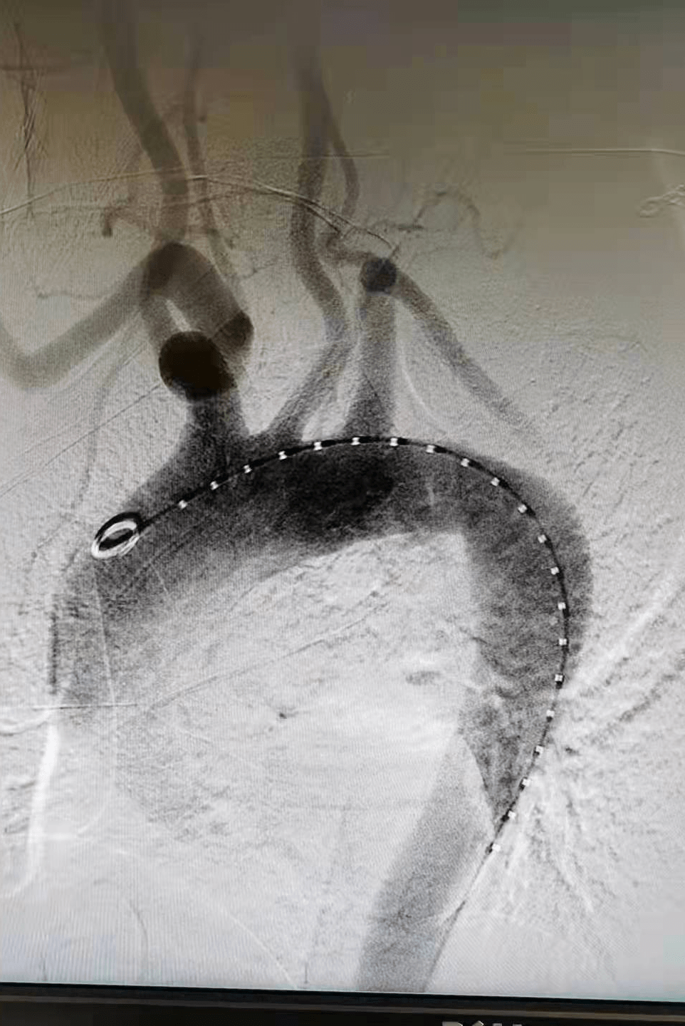 团队|罕见又危险！巨大溃疡长在主动脉上！人民医院专家团队通力合作让患者转危为安