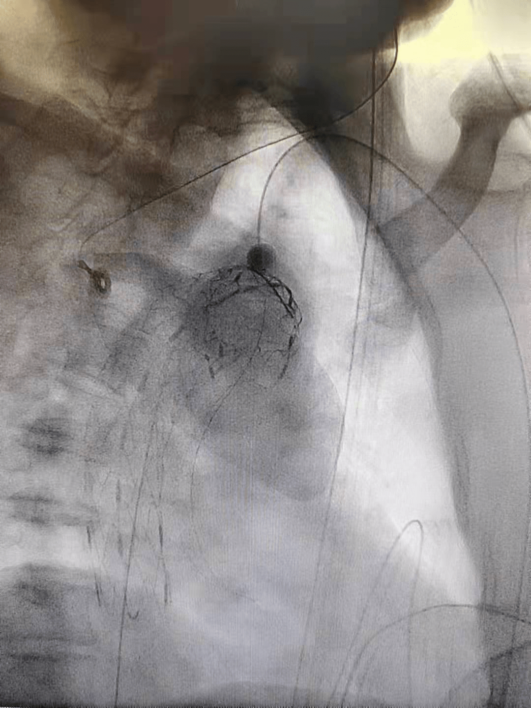 团队|罕见又危险！巨大溃疡长在主动脉上！人民医院专家团队通力合作让患者转危为安
