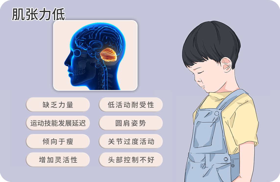 肌张力低下图片