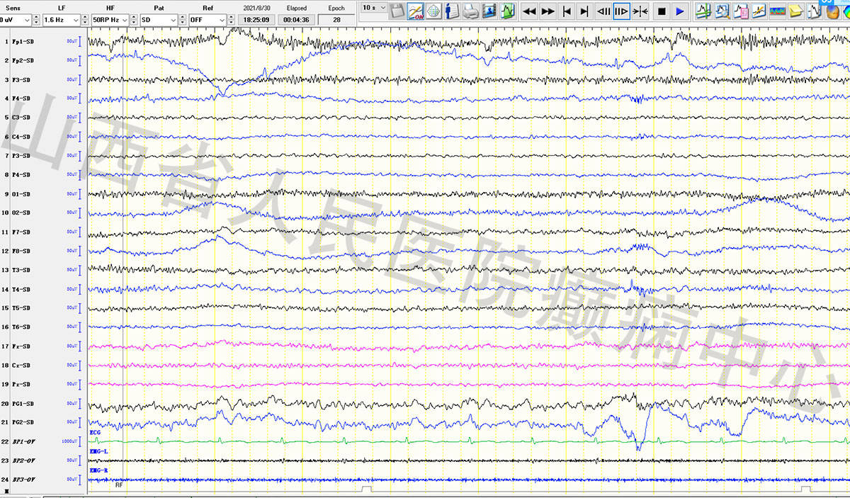 40年癫痫一朝解除,医生:早可以治愈