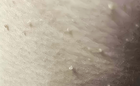 35岁男子感染hpv满脸长"肉芽",妻子怀疑闹离婚,医生:真不怪他