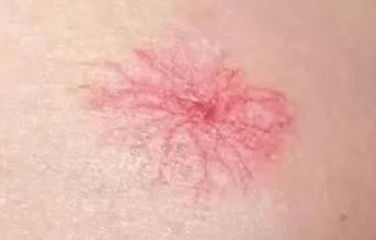 刘杰|43岁农民工皮肤过敏,3个月后确诊肝癌,医生:皮肤3种异常,早做检查