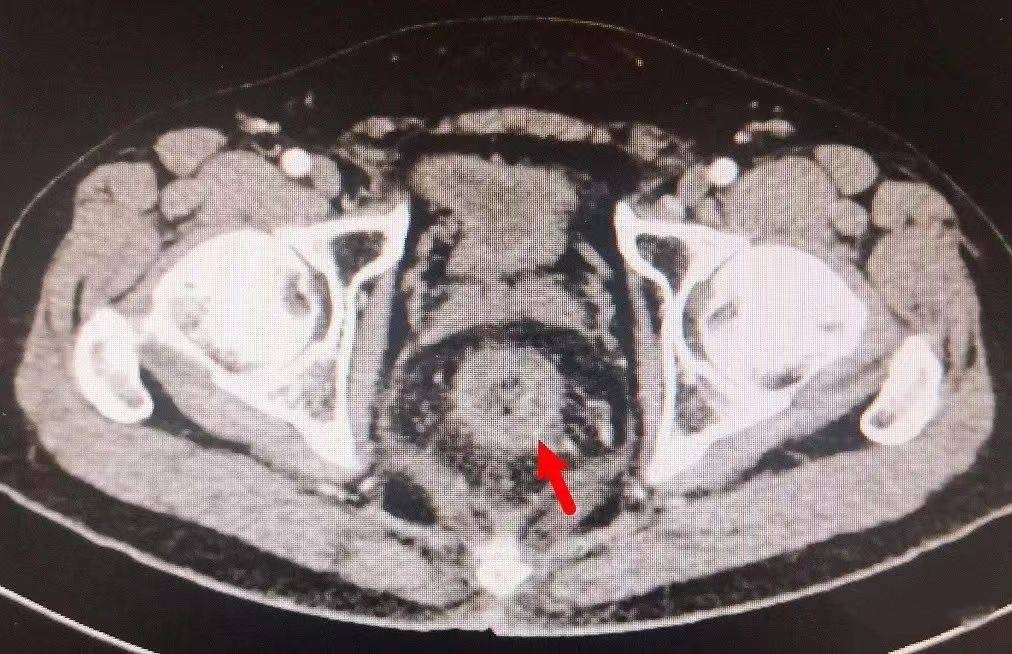 肛门和直肠的CT图图片