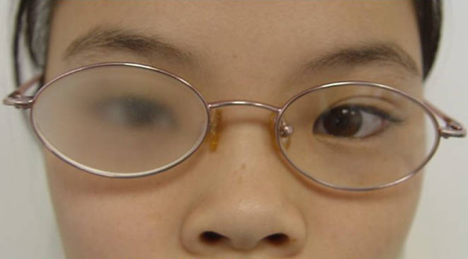 孩子不愿意配合弱视遮盖怎么办眼罩压抑膜电子液晶眼镜优缺点评测