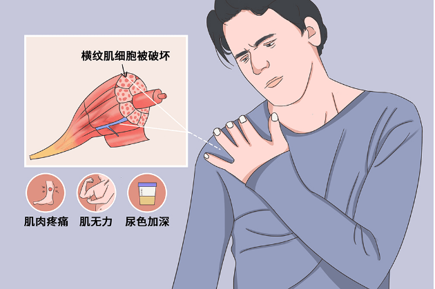 症状|横纹肌溶解症是什么
