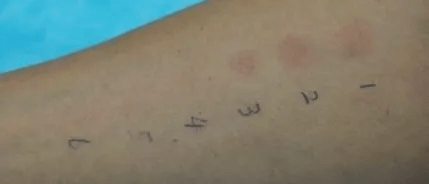 部位|合肥华夏白癜风医院李娜主任解读：MED检测在光疗中的作用