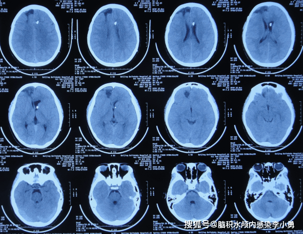 大池|7岁儿童脑出血后脑积水，腰大池引流术后加重感染，顽固性持续发热30余天