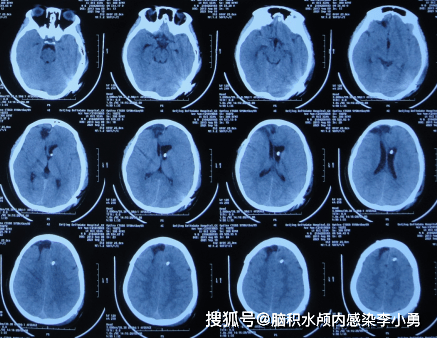 大池|7岁儿童脑出血后脑积水，腰大池引流术后加重感染，顽固性持续发热30余天