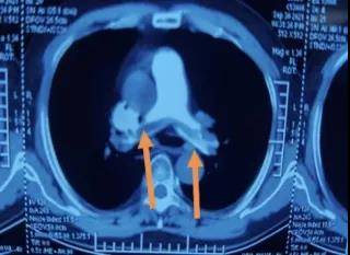 肺动脉|“一根管子” 帮他迈过66岁这道坎儿......