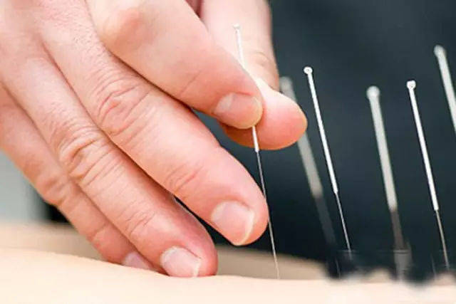 针灸治疗三叉神经痛吗?_肿瘤