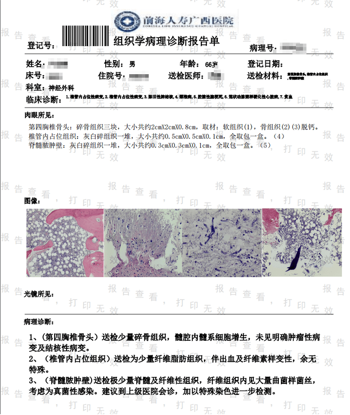 前海人寿广西医院神经外科成功完成一例罕见脊髓真菌脓肿手术