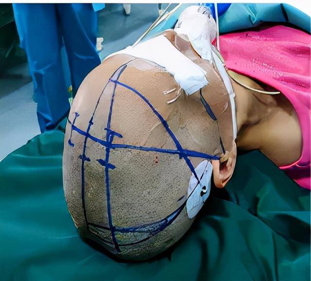 虎威|咸阳市第一人民医院：让每个脑出血患者站起来、走出去