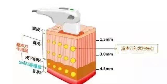 美容美版超声刀效果图片，美版超声刀效果怎么样教你如何防坑~