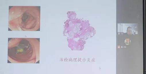 疾病|第二届广仁医学论坛⑧消化疾病内镜诊治高峰论坛成功举行