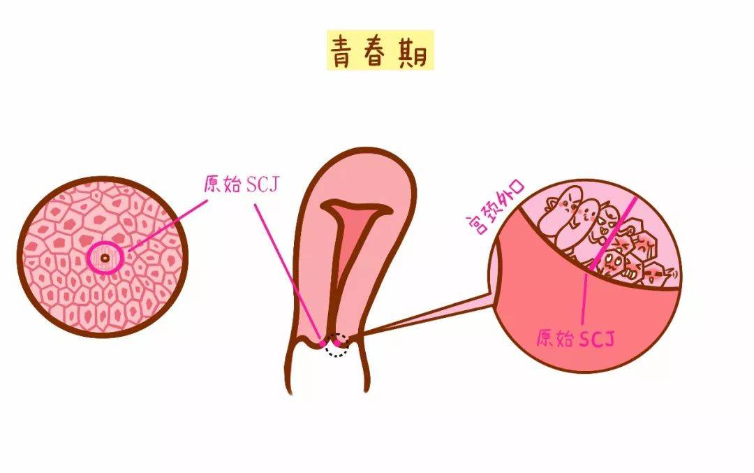 体检查出宫颈囊肿?宫茹清科普囊肿和肌瘤有什么区别?