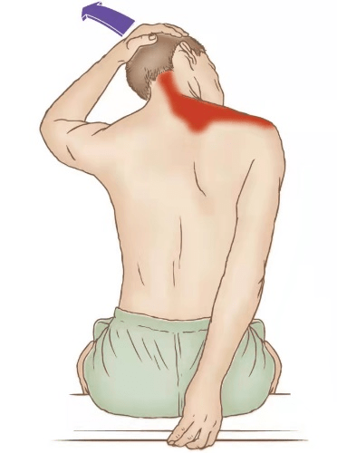 肩胛提肌疼痛图片