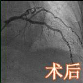 冠状动脉|93岁高龄，8.1厘米巨大腹主动脉瘤，随时可能“爆炸”！